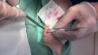 脂肪腫くりぬき法 30代女性腕epidermal cyst atheroma cystic acne extraction 粉瘤lipoma クリニーク大阪心斎橋・大阪梅田・名古屋栄・福岡天神・神戸院