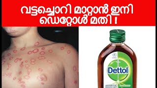 വട്ടച്ചൊറി മാറ്റാൻ ഇനി   ഡെറ്റോൾ മതി !!  Home Remedies For Ringworm