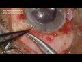 Phacosection & Trabeculectomy at duel sites, under topical, for cataract & advanced glaucoma.