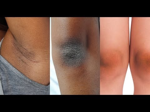 Miracle Solutions for Dark and Dry Skin or Dark elbow | All About your Health Miracle Solutions for Dark and Dry Skin or Dark elbow | All About your Health