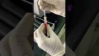 Esr westergren method #laboratory #testing #test #bloodtest #khanzaki #path #medicalstudent