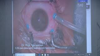 AIOC2020 VT Post Seg Dr Narayanan R A unique way of managing coats maculopathy  intraretinal macular