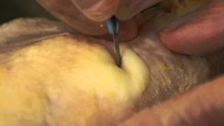 Understand Wound Care: Incision \u0026 Drainage Demonstration