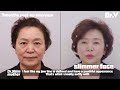 facelift blepharoplasty review v.lif plastic surgery in korea