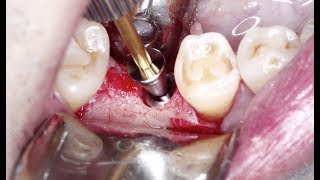 Case of the Week: A Straightforward Implant Case on Tooth #30