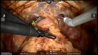 RobotiX Mentor - Prostatectomy - Bladder Neck Dissection