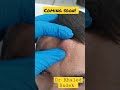 massive forehead cyst. Dr Khaled Sadek #drkhaledsadek #blackheads #cystremoval