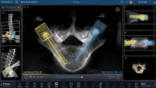 Medtronic | Mazor X Spinal Robotics - Preop Planning, L4-5 Minimally Invasive Spinal Fusion