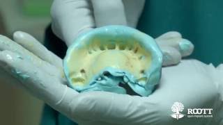 Clinical surgery successfully performed by Dr. Yousef Abd ElGhaffar using Compressive dental implant