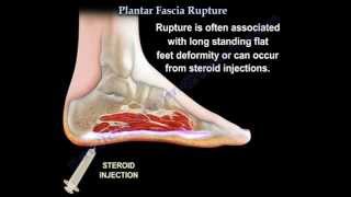 Plantar Fascia Rupture - Everything You Need To Know - Dr. Nabil Ebraheim