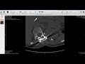 VISOR DICOM HOROS : OSIRIX 5