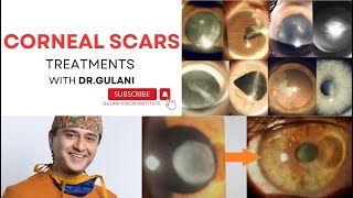 #cornealscars treatments to 20/20: #SWEDEN to @GulaniVision  In The NEWS