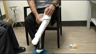 Renowned Prosthetic Designer Meets With Local Patients To Change Lives