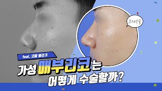 [First Re:View] 가성매부리코 무보형물 복코교정  👃✨ | 처음처럼성형외과