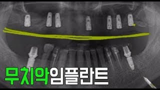 무치악임플란트 [치료기간 동안 식사는 어떻게 할까요?]