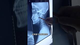 椎间盘突出腰椎管狭窄颈椎病胸腰椎骨折腰椎滑脱