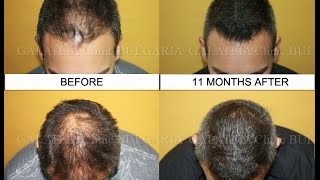 Hair Transplantation-2500 grafts/Трансплантация на коса-2500 присадки/д-р Зарев