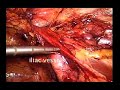 extraperitoneal anatomy as viewed with the e.t.e.p technique.mov