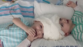 Conjoined twins separated during rare surgery