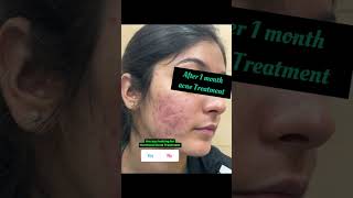 Before and After Hormonal Acne Treatment #drashimagoel #parisaskinclinic #dermatologistinchandigarh