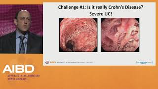 Challenges in the treatment of severe Crohn's disease