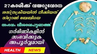 അത്യപൂര്‍വ്വം, 27കാരിയുടെ വയറ്റില്‍നിന്ന് നീക്കിയത് സ്‌റ്റോണ്‍ ബേബിയെ #stonebaby #healthnews