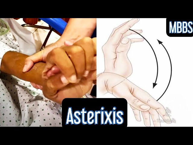 Asterixis: What Is It, Causes, Liver, And More, 53% OFF