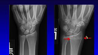 2.Jim S. Wu_Diagnostic Pitfalls in MSK Trauma Radiography