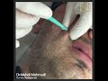 sızanaq Çapıq və İzlərin müalicəsi dermatoloq dr mehdi