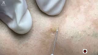 Big Cystic Acne Blackheads Extraction Blackheads \u0026 Milia, Whiteheads Removal Pimple Popping #shorts