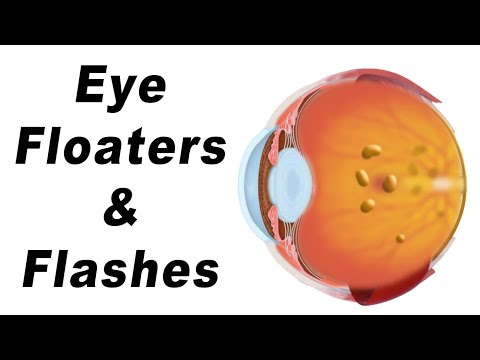 Can stress cause floaters?