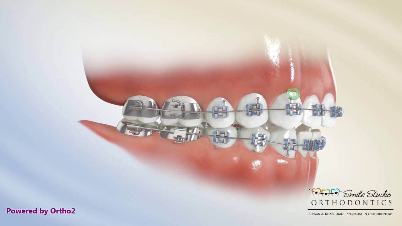 Class 2 Elastics Orthodontics