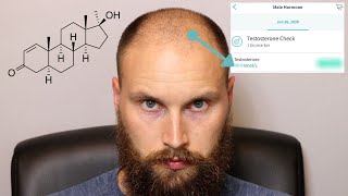 BALDING AND TESTOSTERONE - Testosterone Levels of a 29 Year old Balding Man