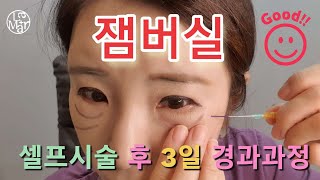 잼버실 셀프시술과 놀라운 3일간의 변화과정을 영상으로 보여드립니다