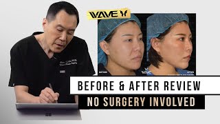 Before and After Reviews: A Complete Non-Surgical Makeover | Wave Plastic Surgery