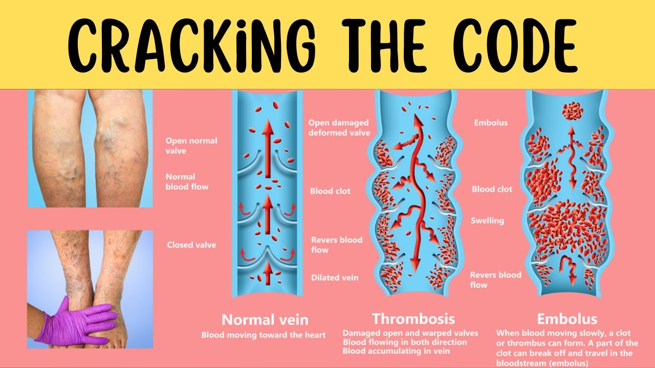 Delicious Secrets To Naturally Dissolve Blood Clots! - YouTube