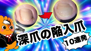 爽快！巻き爪矯正改善集〜深爪の陥入爪編〜【巻き爪先生 Vol.5  】by Pincer Nails treatment Center®︎