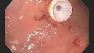 Endoscopic placement of percutaneous endoscopic gastrostomy feeding tube