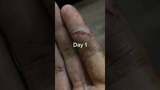 30 days Nasty finger cut wounds healing time lapse