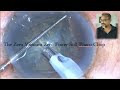 The zero vacuum - zero power - Phaco Chop in soft cataracts