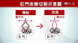 痔瘡困擾 肛門狹窄處處不方便...