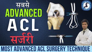 सबसे Advanced ACL सर्जरी कौनसी है? Most Advanced #ACL #Surgery Technique FiberTape Internal Brace