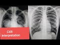 Chest x-ray interpretation @RadiologyChannel @RadiologyVideo