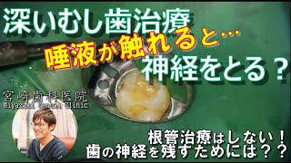 深いむし歯治療で唾液が触れると神経をとらなくてはいけない？露髄すると神経の治療が必要？マイクロスコープとラバーダムとMTAで神経を残す治療。