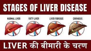 कैसे पता करे आपकी लिवर कौन सी स्टेज में खराब है? | 4 Stages Of Liver Disease In Hindi