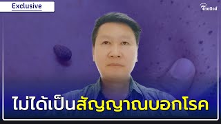 อย่าเพิ่งตกใจ ติ่งเนื้อขึ้นที่คอ ที่แท้ไม่ได้เป็นสัญญาณบอกโรค| Thainews - ไทยนิวส์