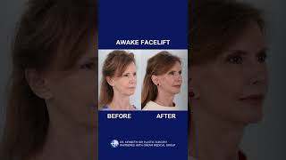 AWAKE FACELIFT