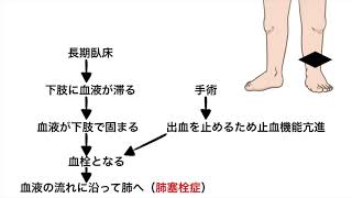 看護師が雑に深部静脈血栓症について教えるよ