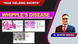 High Yielding Shorts-34 (#HYS-34): Whipple’s disease by Dr Devesh Mishra.