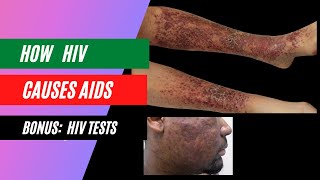 how does HIV cause aids?